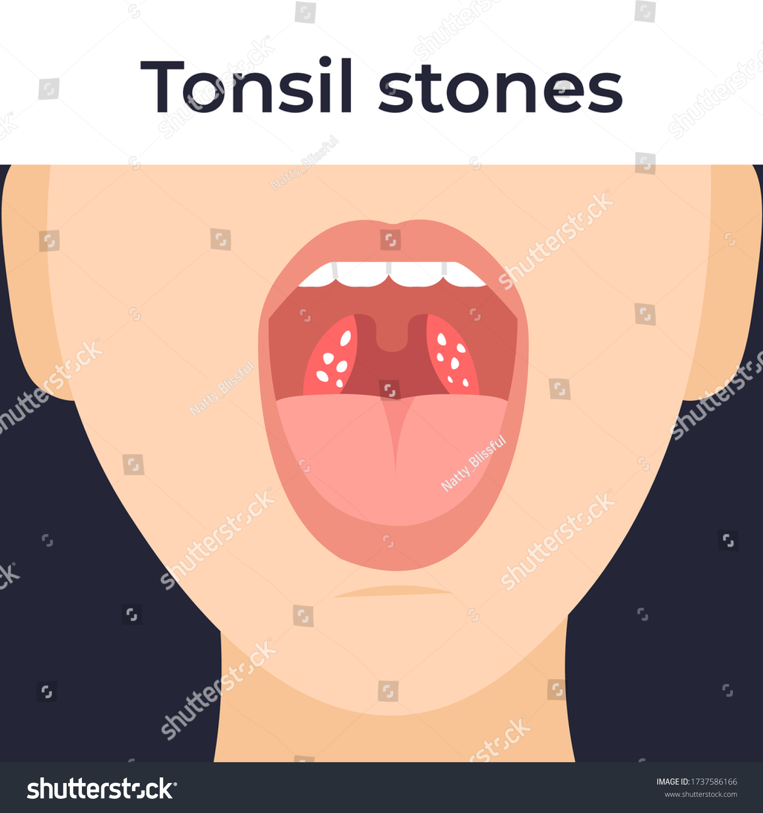 Tonsil Stones Throat Tonsilloliths Flat Vector стоковая векторная