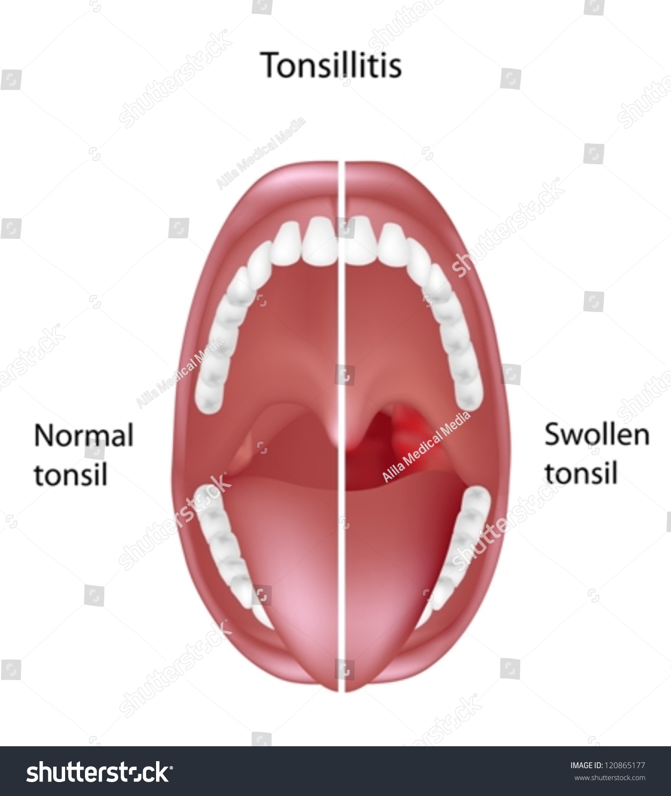 Tonsillitis Stock Vector Illustration 120865177 : Shutterstock