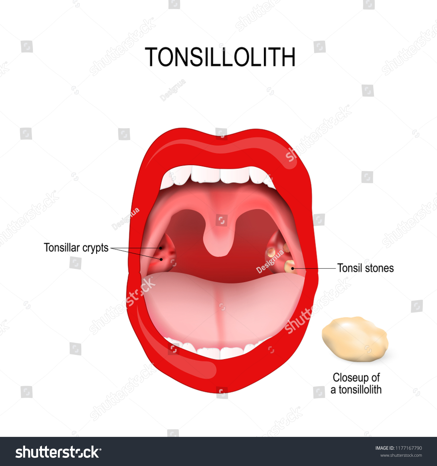 Tonsillolith Lodged Tonsillar Crypt Closeup Tonsil Stock Vector Royalty Free 1177167790