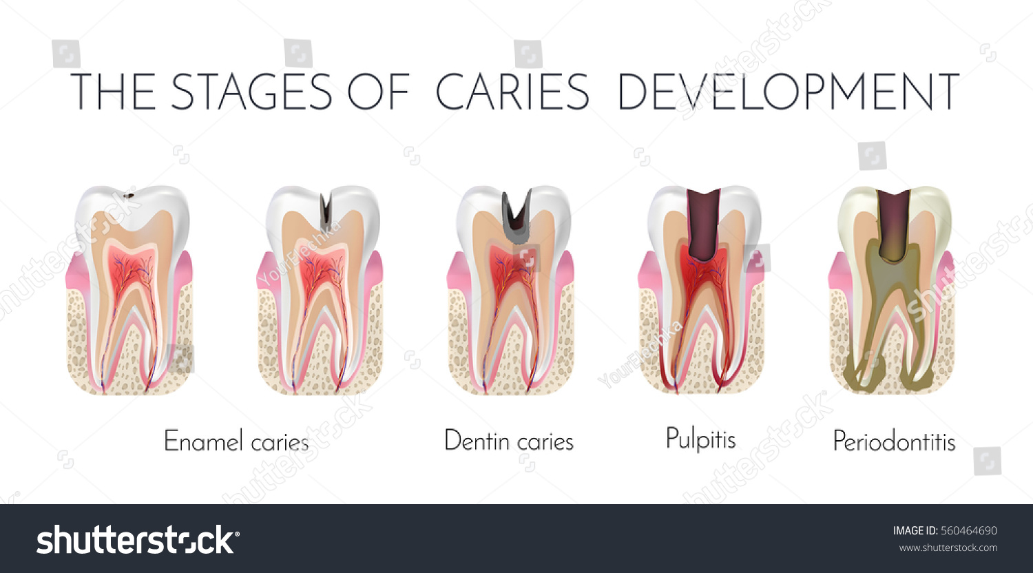 Stages Of Dental Caries