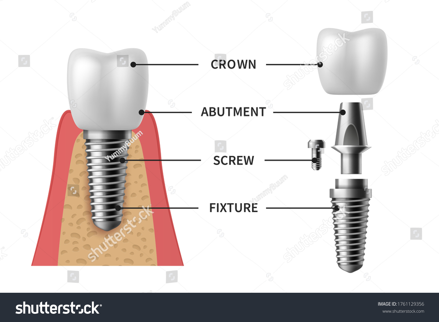 Implant Screw Images Stock Photos Vectors Shutterstock   Stock Vector Tooth Implant Realistic Implant Structure Pictorial Models Crown Abutment Screw Denture 1761129356 