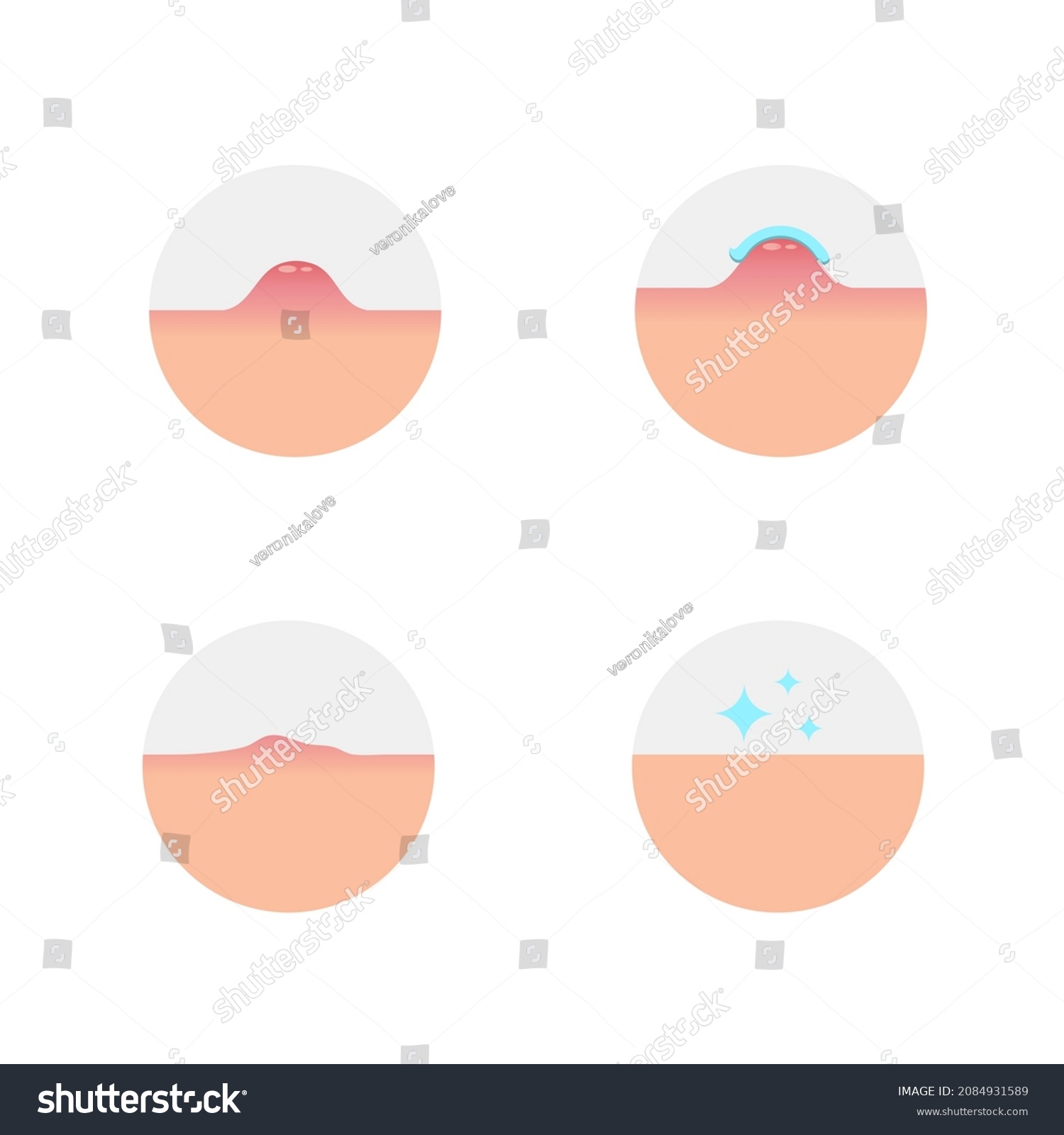 1,603 Blister skin vector Images, Stock Photos & Vectors | Shutterstock