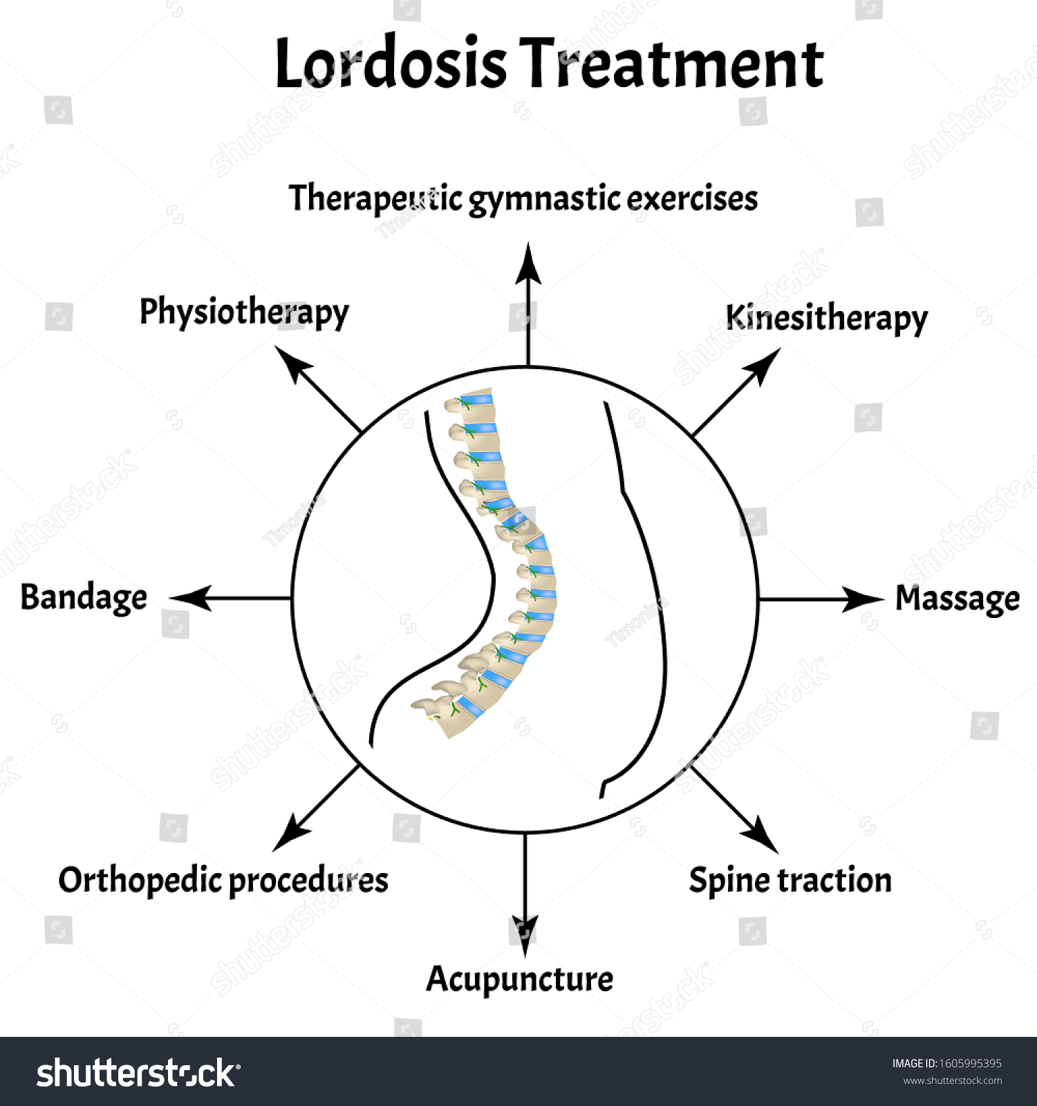 Kyphosis Lordosis And Scoliosis Spine Curvature Disorders Treatment