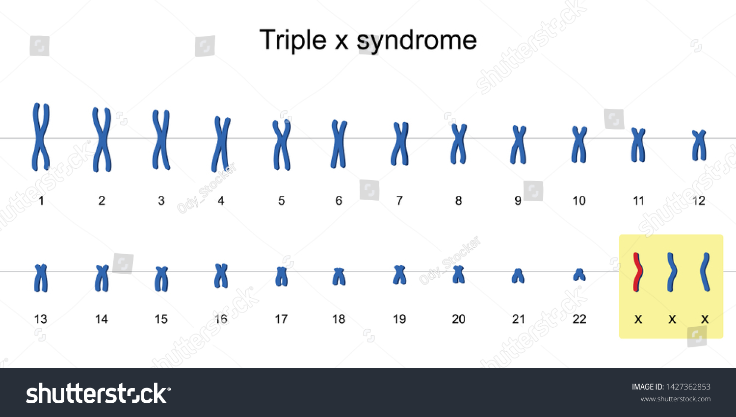 Triple X Syndrome Karyotype Nondisjunction Sex Vector De Stock Libre