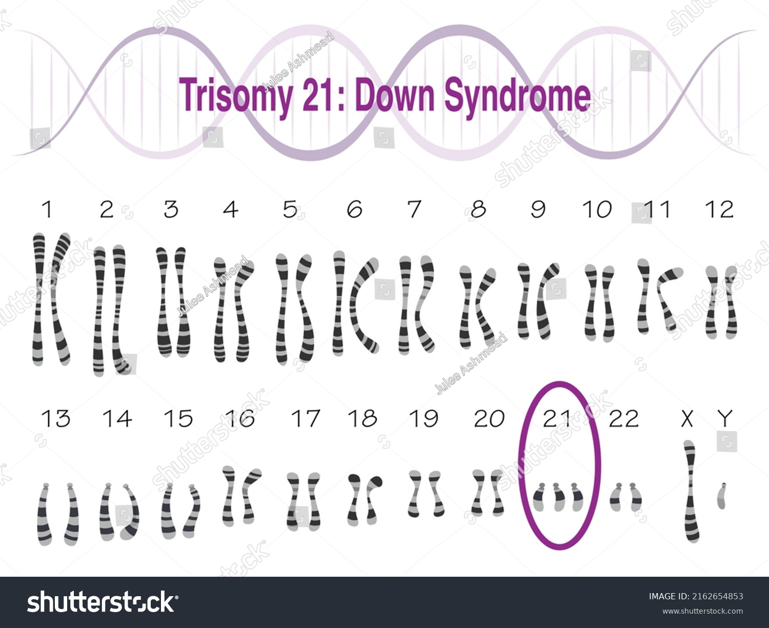 Trisomy 21 Down Syndrome Karyotype Stock Vector Royalty Free 2162654853 Shutterstock 6479