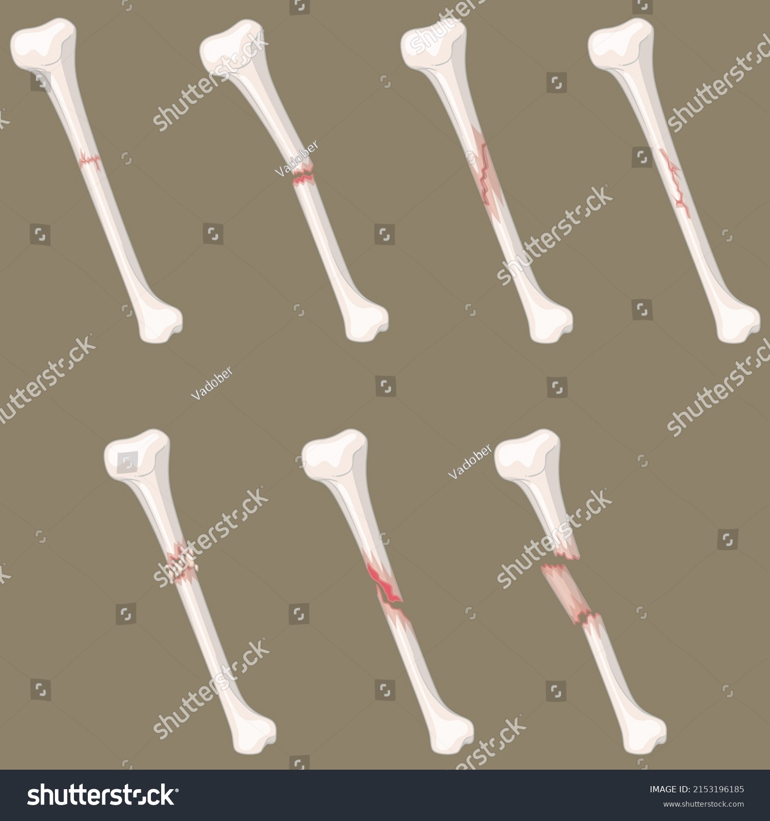 Type Bones Fractures Drawings Stock Vector (Royalty Free) 2153196185 ...