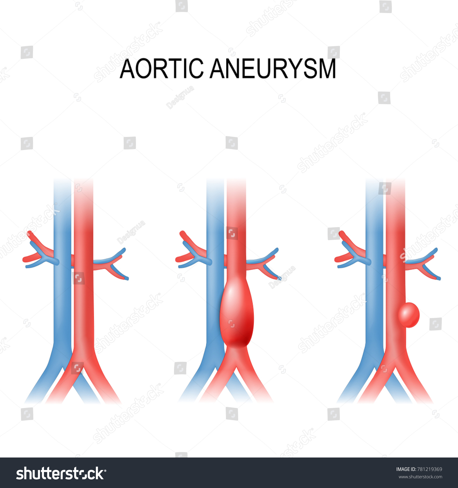 Types Abdominal Aortic Aneurysm Normal Aorta Stock Vector Royalty