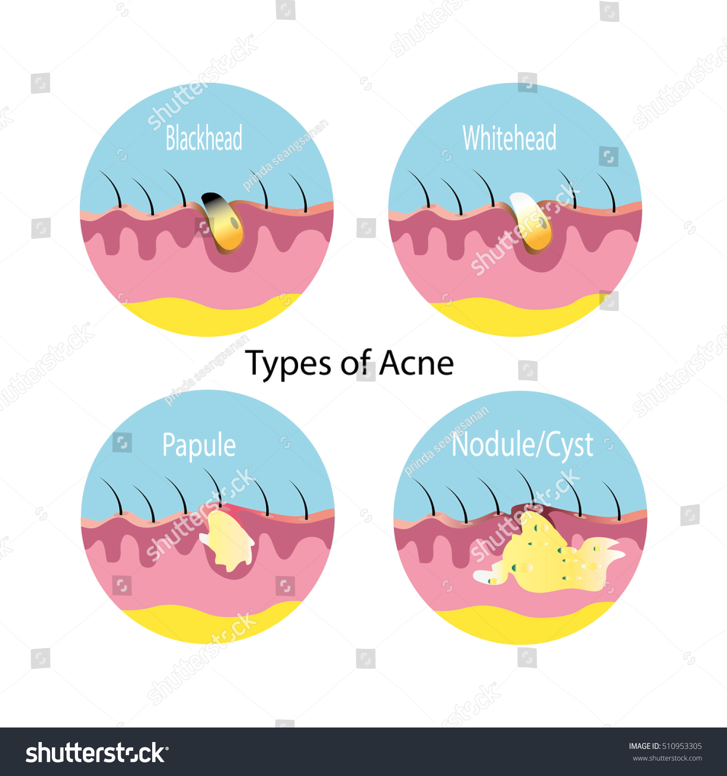 Types Acne Stock Vector (Royalty Free) 510953305 | Shutterstock