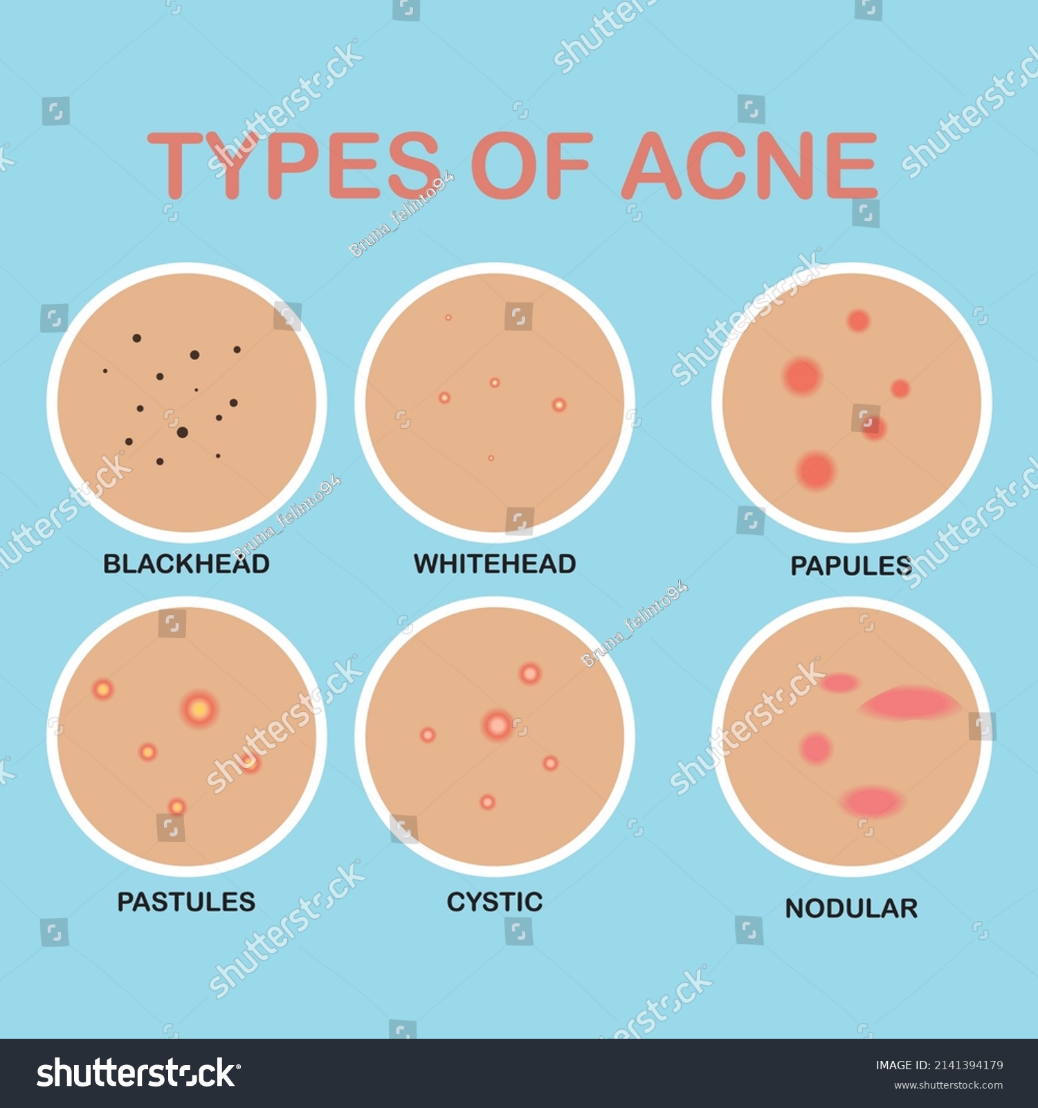 Types Acne Pimples Skin Pores Blackhead Stock Vector (Royalty Free ...