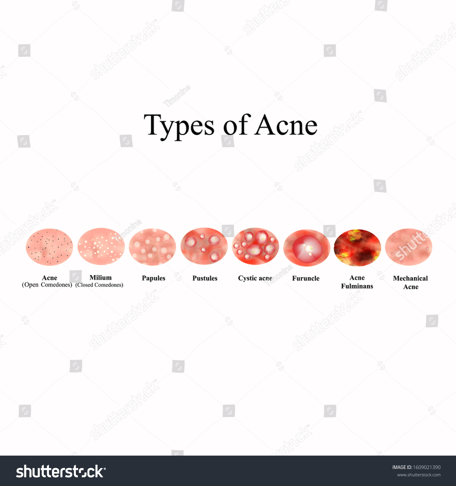 Types Acne Skin Inflammation Pimples Boils 库存矢量图（免版税）1609021390 Shutterstock 