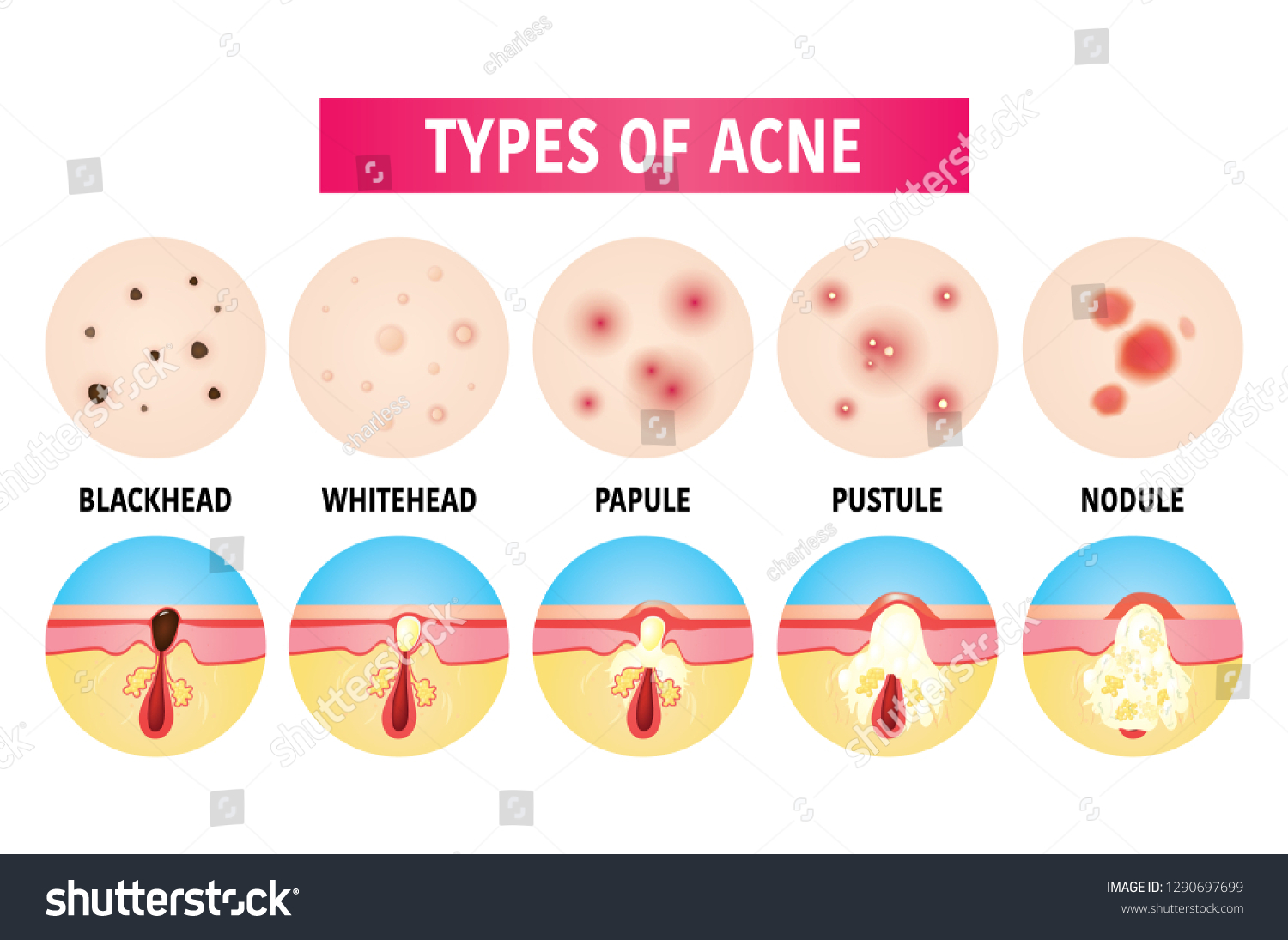 Vektor Stok Types Acne Vector Illustration Tanpa Royalti 1290697699