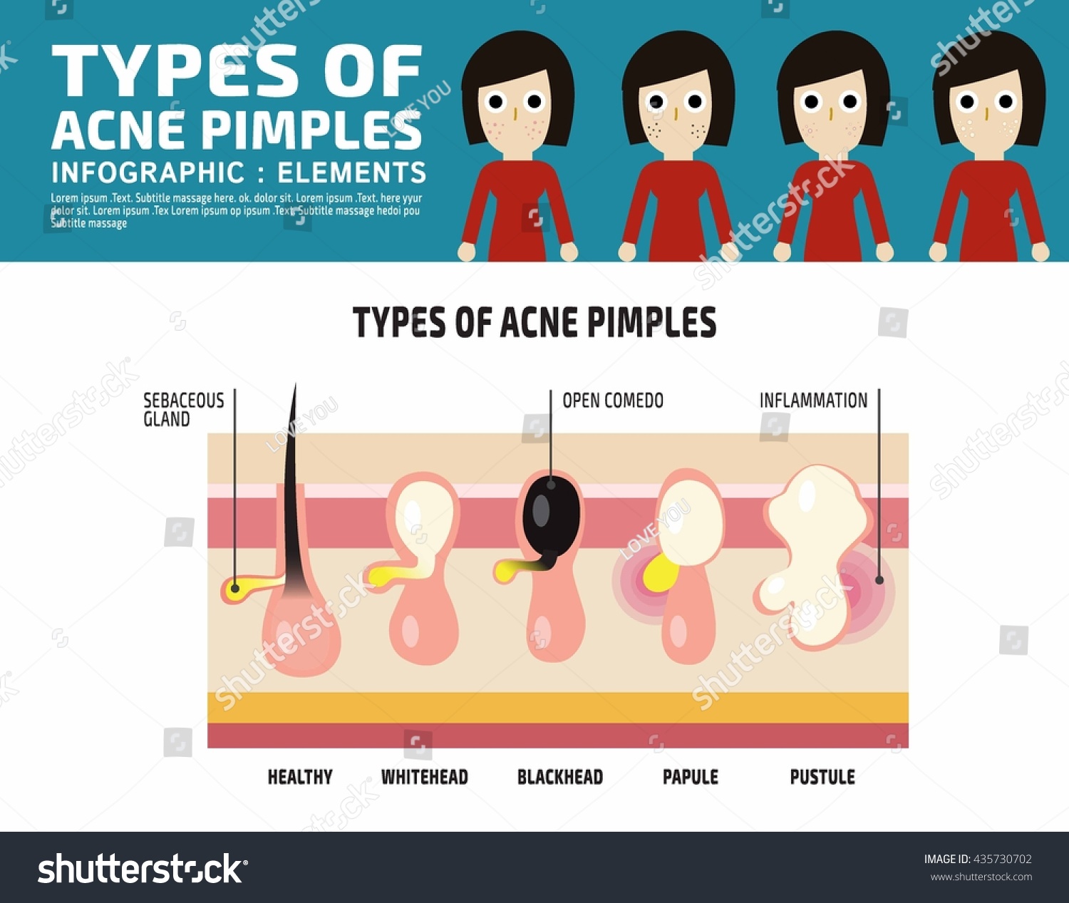 List 98+ Images Types Of Acne With Pictures Updated 12/2023