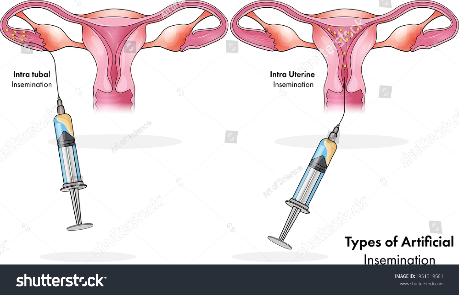 types-artificial-inseminations-intra-uterine-intra-stok-vekt-r