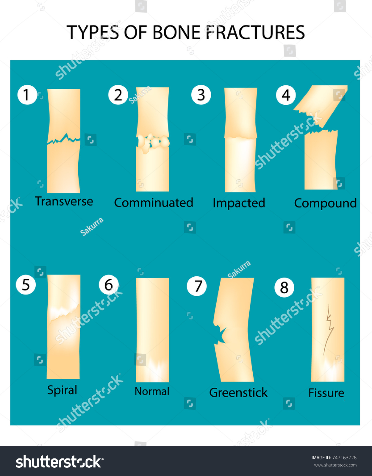 Types Bone Fractures Human Anatomy Vector Stockvektor Royaltyfri 747163726 Shutterstock 3422