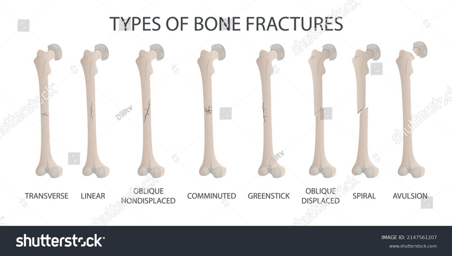 Types Bone Fractures Illustration Showing Broken Stock Vector (Royalty ...