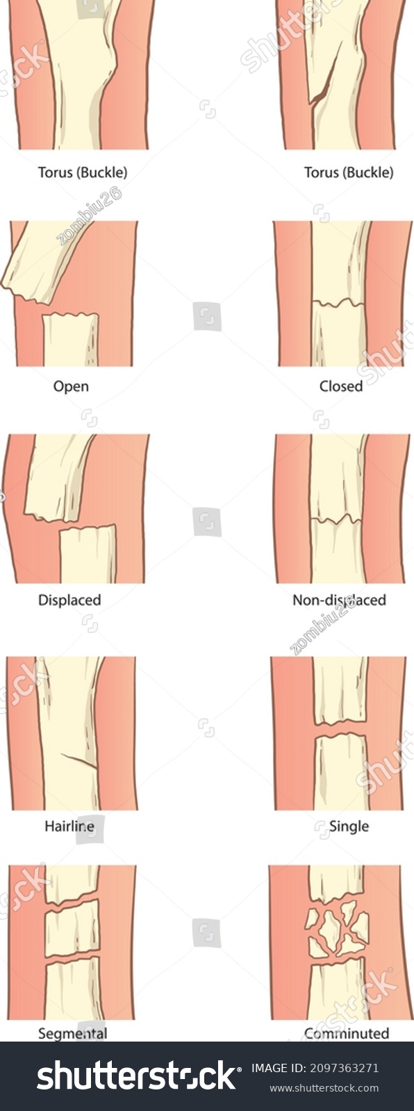 Types Bone Fractures Infographic Vector เวกเตอร์สต็อก ปลอดค่าลิขสิทธิ์ 2097363271