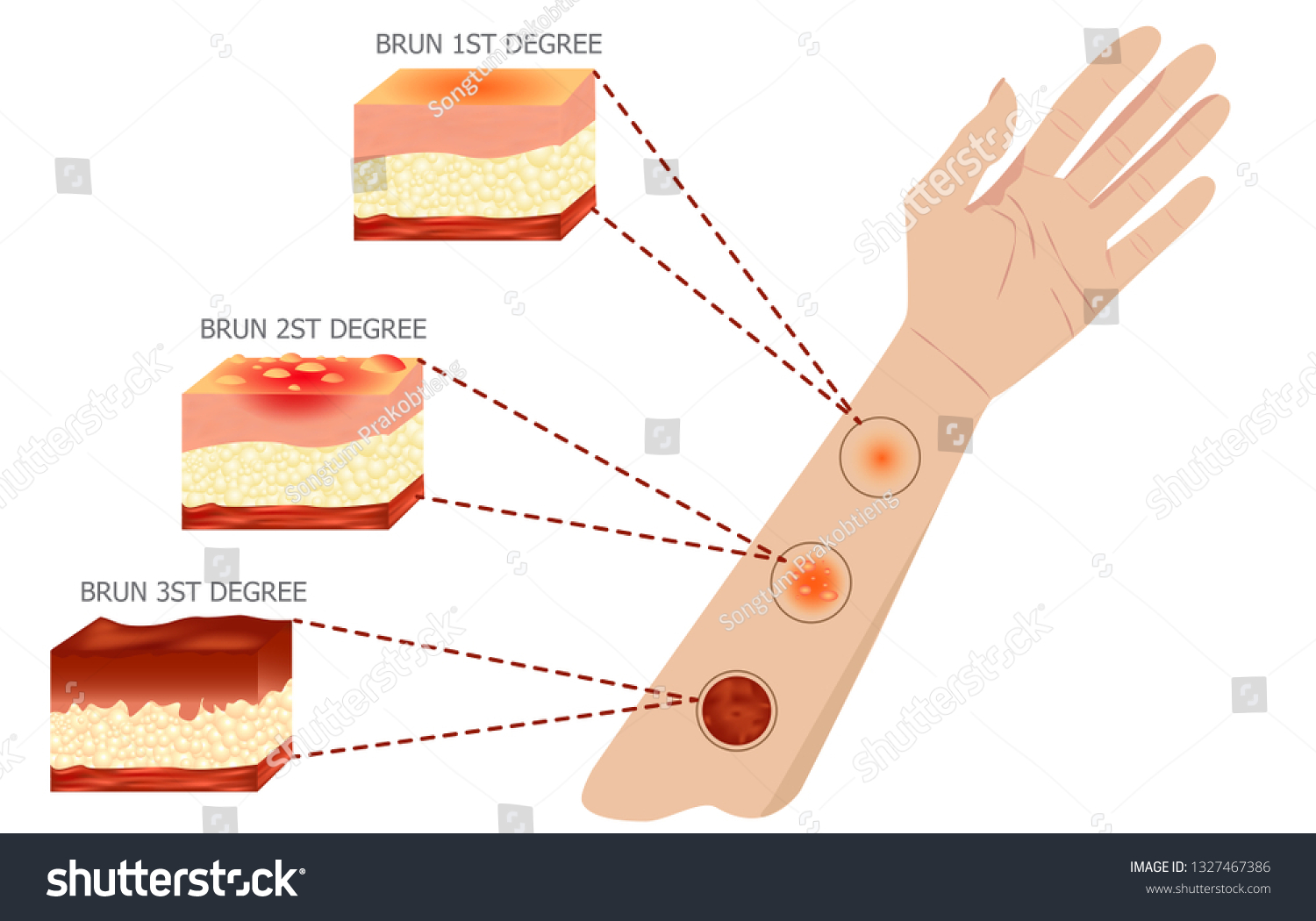 2,471 Degree burns Images, Stock Photos & Vectors | Shutterstock