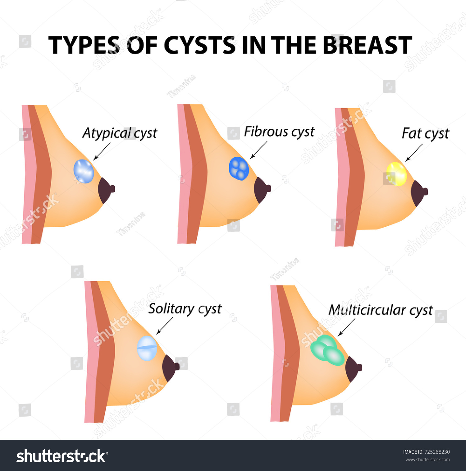 types-cysts-breast-atypical-fibrous-fatty