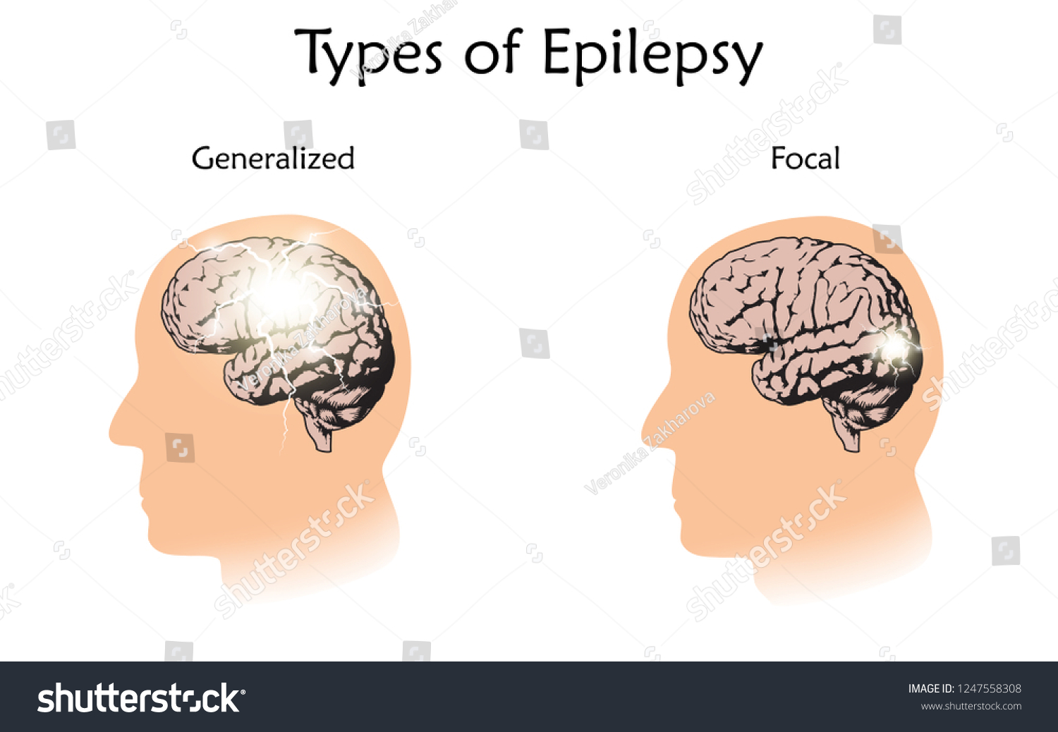 Types Epilepsy Vector Medical Illustration Generalized Image Vectorielle De Stock Libre De 5856