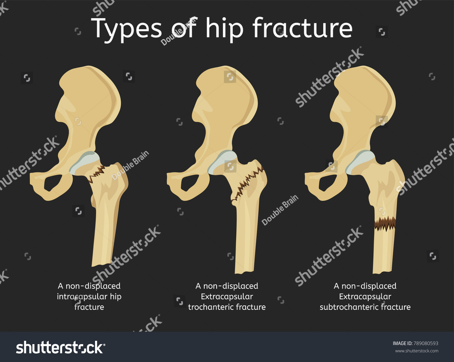 Types Hip Fracture Nondisplaced Intracapsular Extracapsular Stock Vector Royalty Free