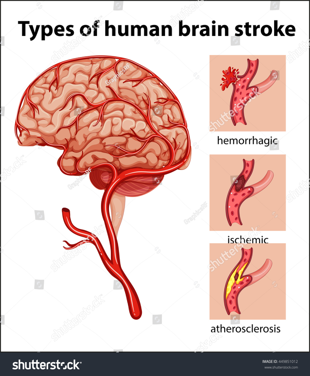 Types Human Brain Stroke Illustration Stock Vector 449851012 - Shutterstock