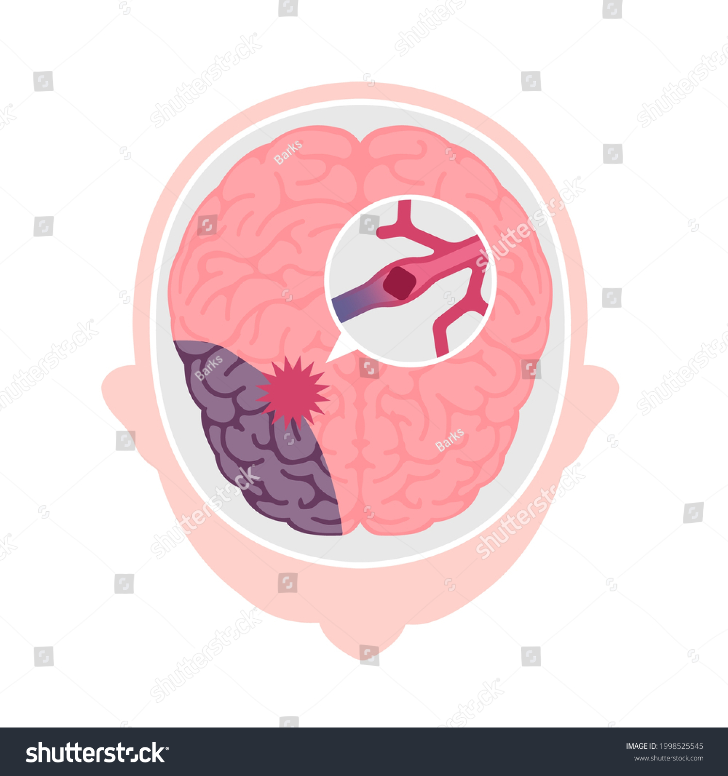 Types Human Brain Stroke Vector Illustration Stock Vektor Royaltyfri 1998525545 Shutterstock 5967