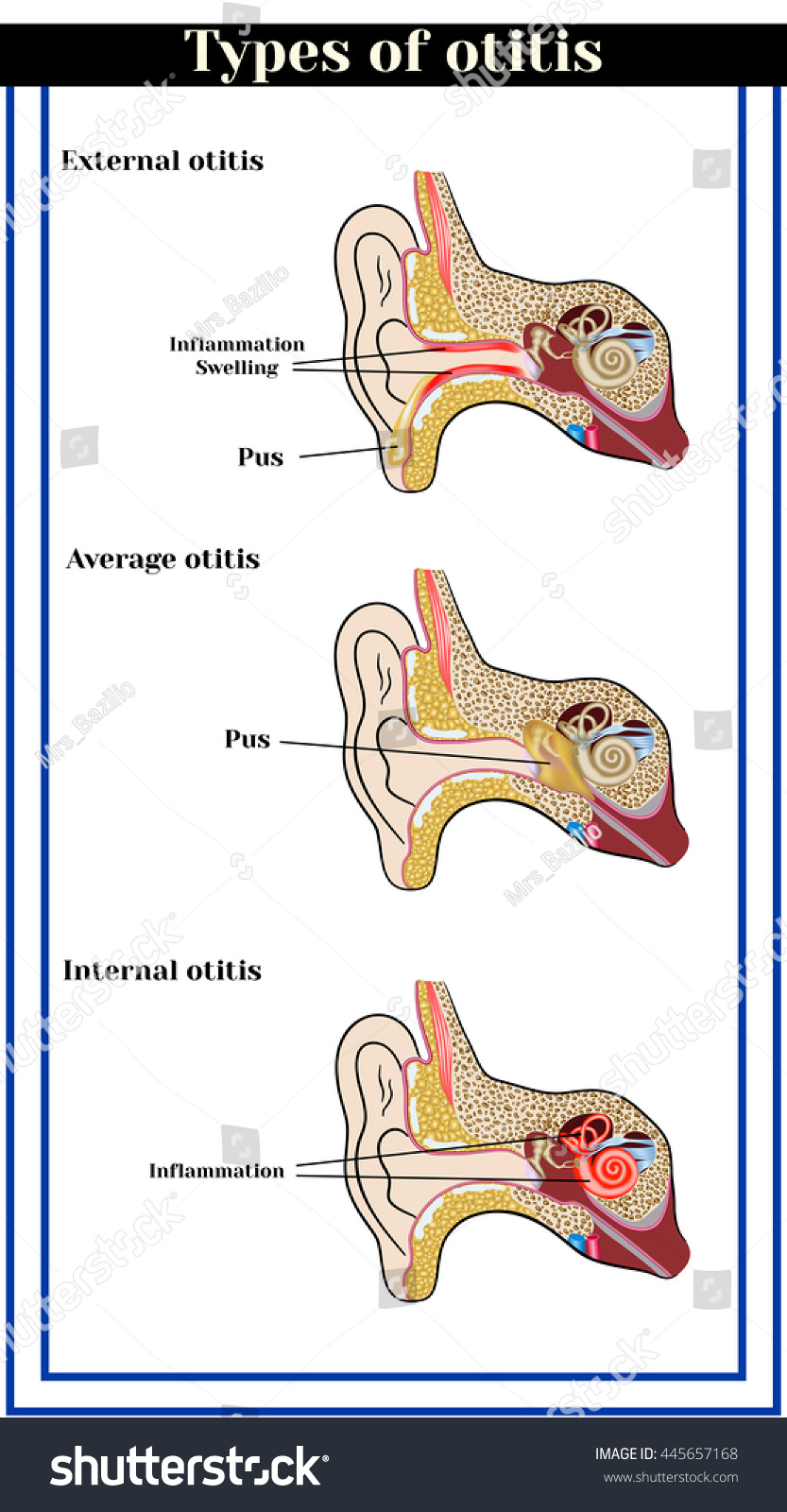 Types Of Otitis : External, Average And Internal Otitis. Inflammatory ...