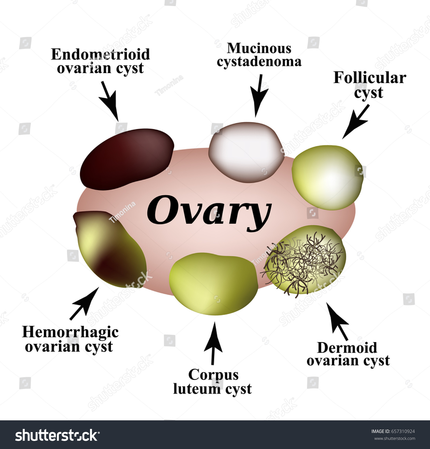 types-ovarian-cysts-set-infographics-vector-stockvektor-royaltyfri