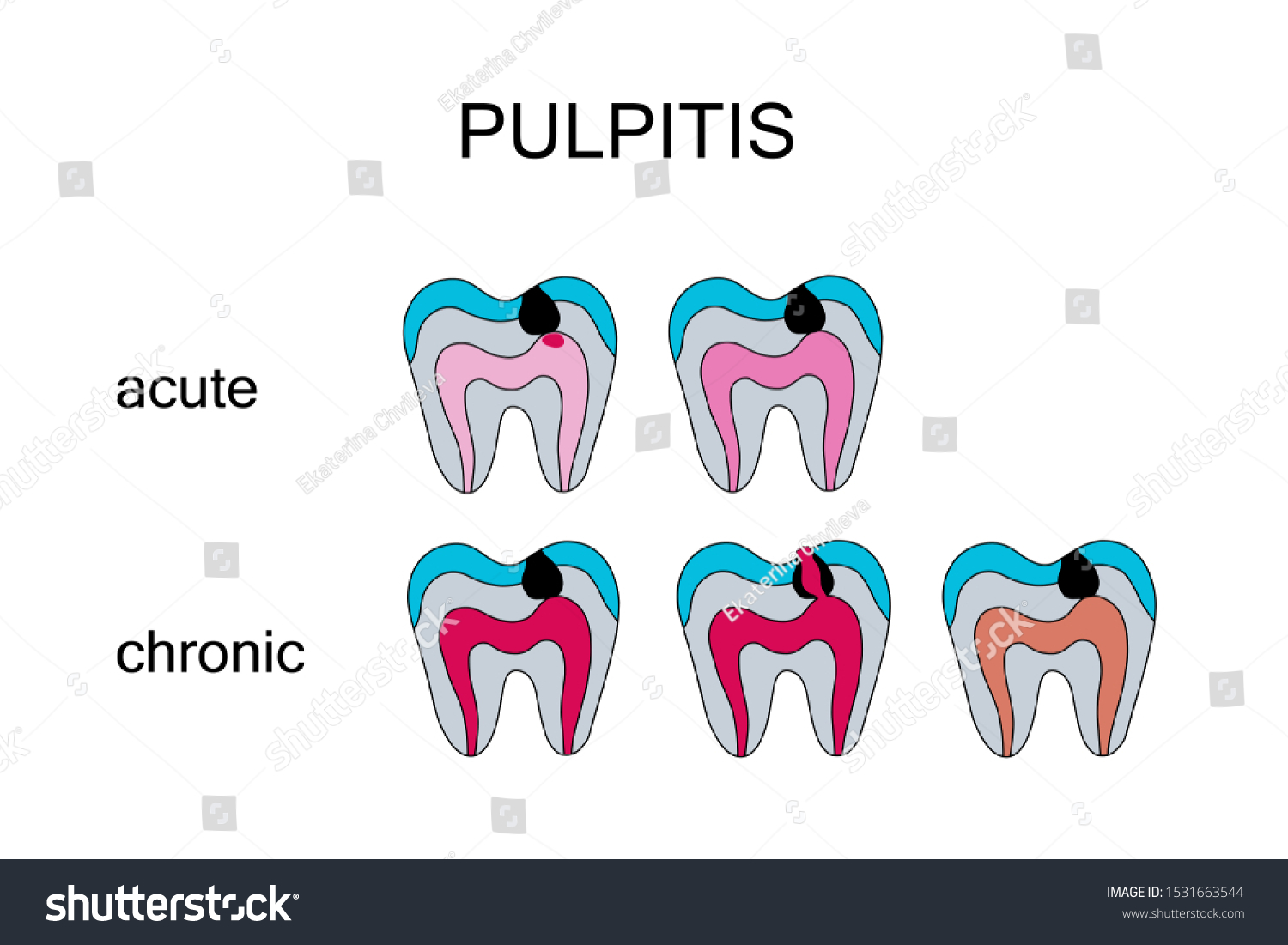 Types Pulpitis Hand Drawn Vector Illustration Stock Vector (Royalty ...