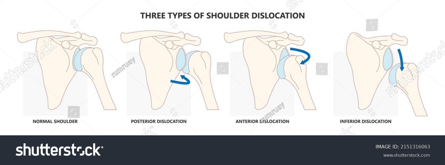 Types Traumatic Injury Shoulder That Glenohumeral Stock Vector (Royalty ...