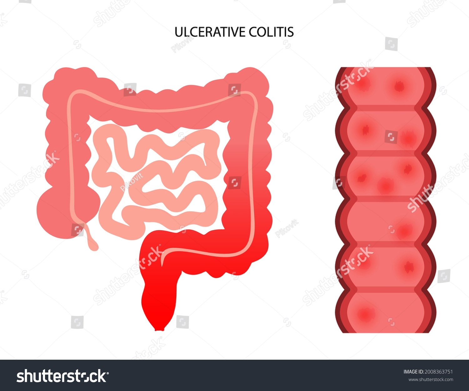 Ulcerative Colitis Concept Inflammatory Bowel Disease Stock Vector Royalty Free 2008363751 0670