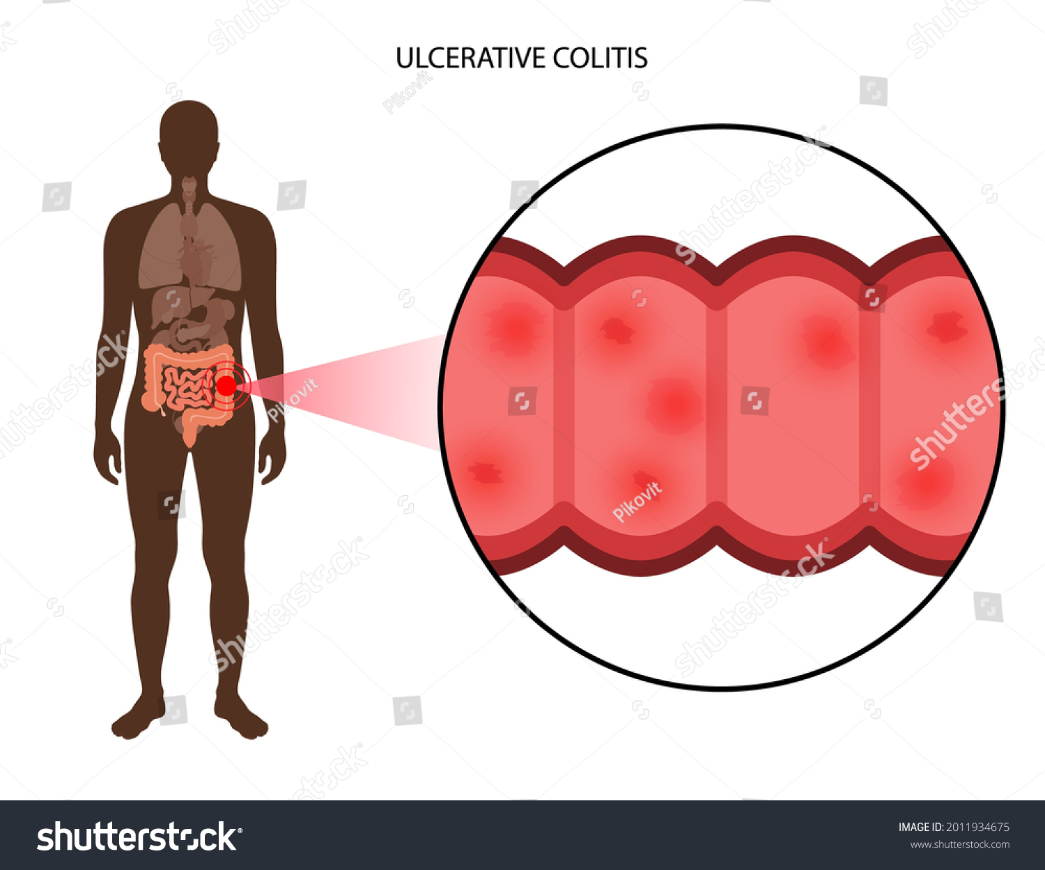 Ulcerative Colitis Concept Inflammatory Bowel Disease Stock Vector Royalty Free 2011934675 6145