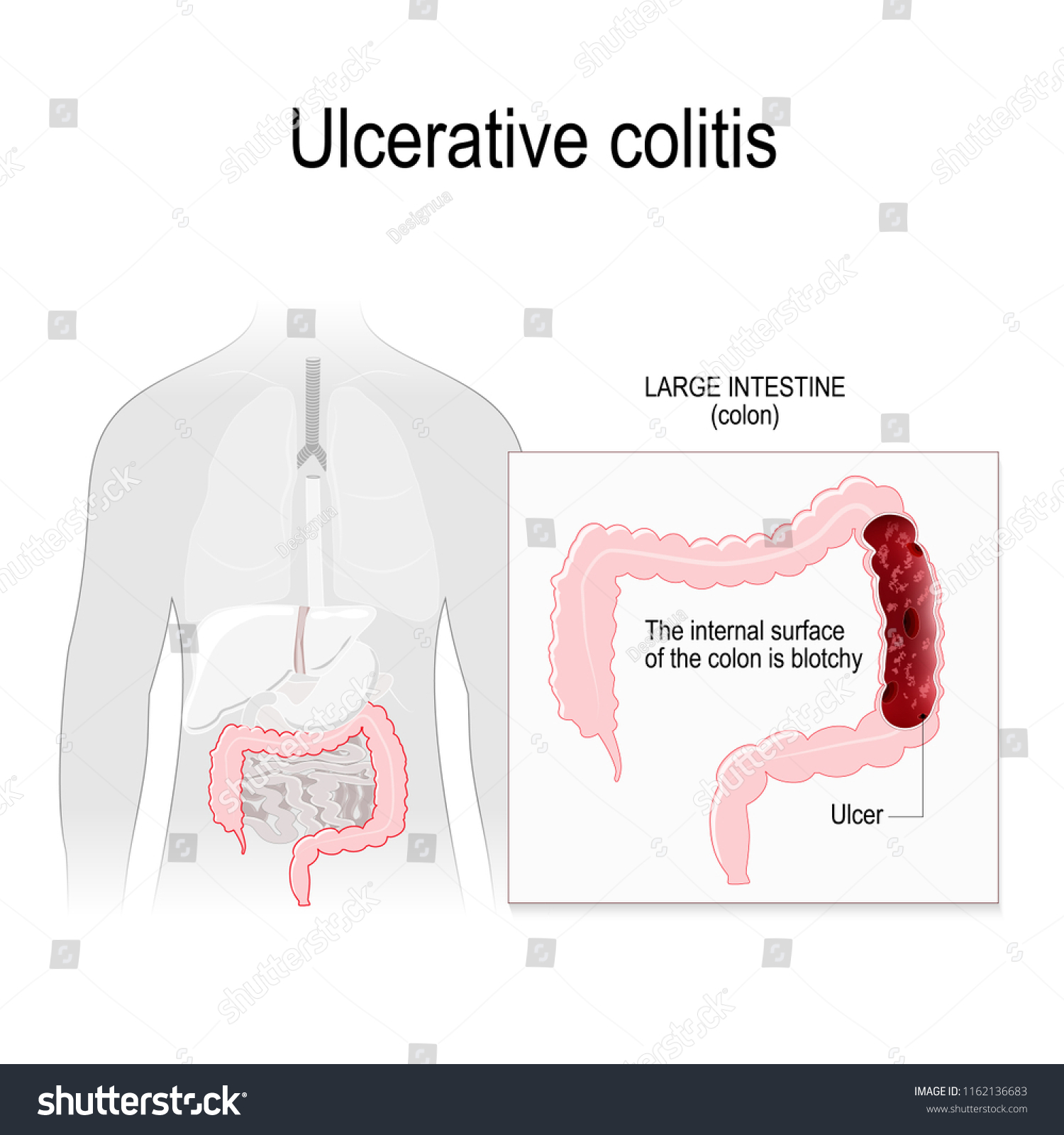 Ulcerative Colitis Inflammation Ulcers Colon Rectum Stock Vector Royalty Free 1162136683 