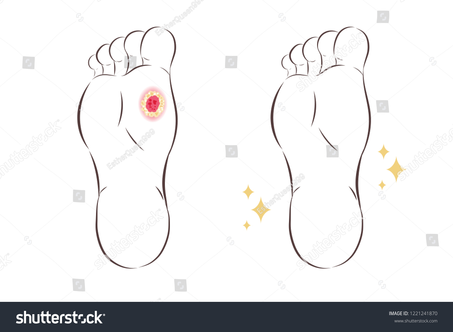 Ulcers On Inside Plantar Foot Diabetic Stock Vector (Royalty Free ...