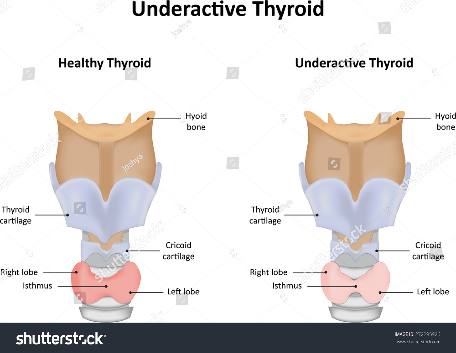 4-under-active-thyroid-gland-shutterstock