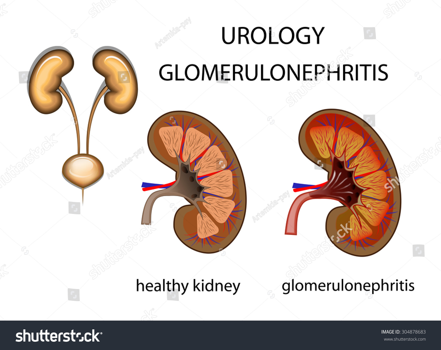 Urology Healthy Kidney Glomerulonephritis Comparison Stock Vector ...