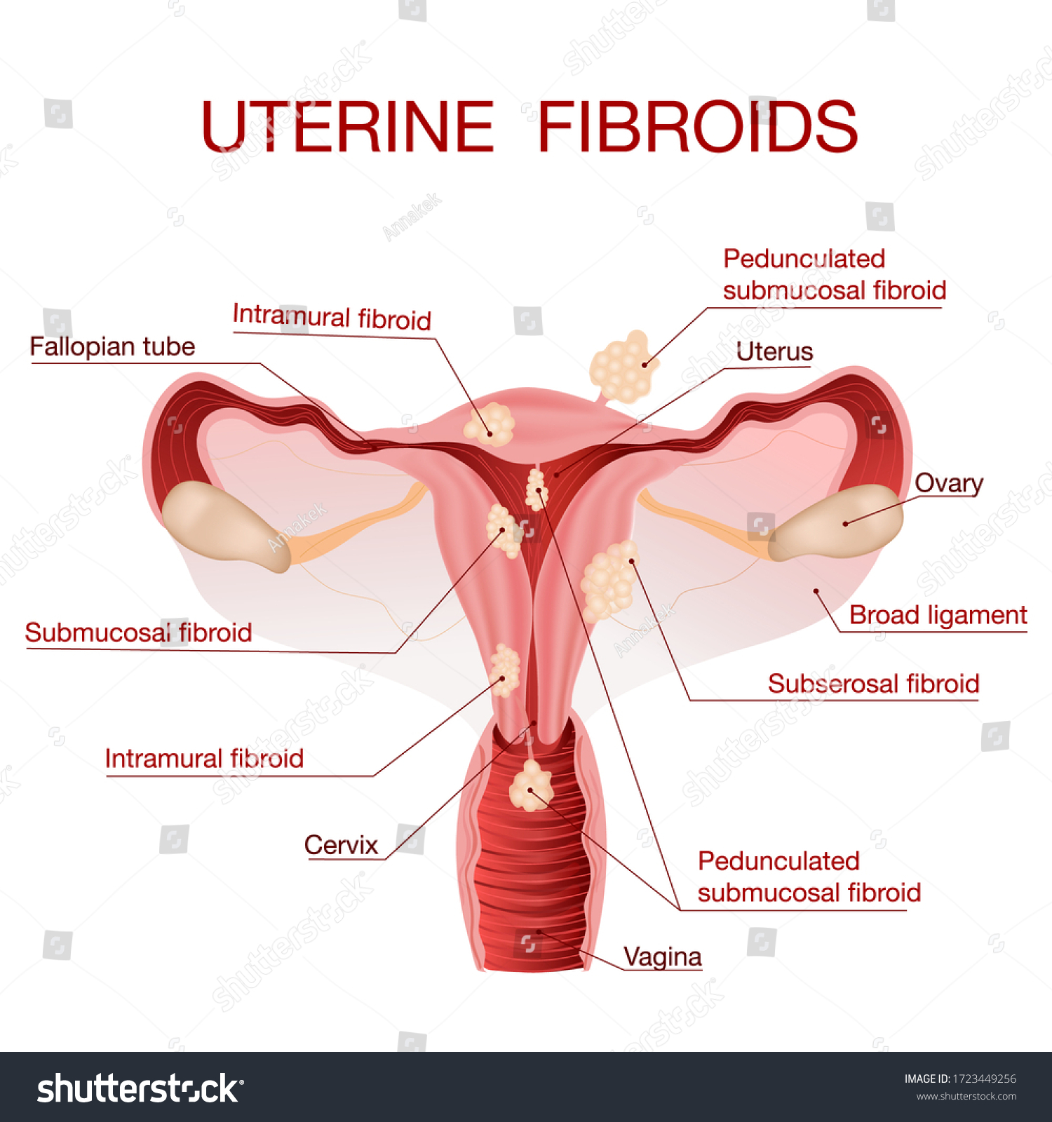 Uterine Fibroidsa Schematic Illustration Uterus Female Stock Vector