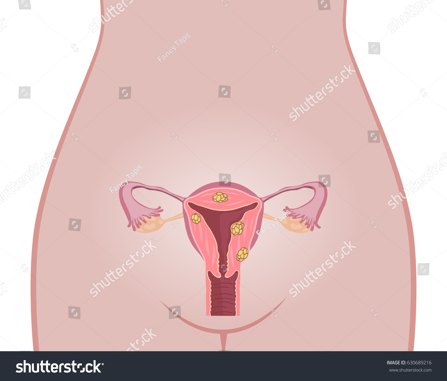 Uterine Fibroids Vector Illustration Flat Design Stock Vector Royalty