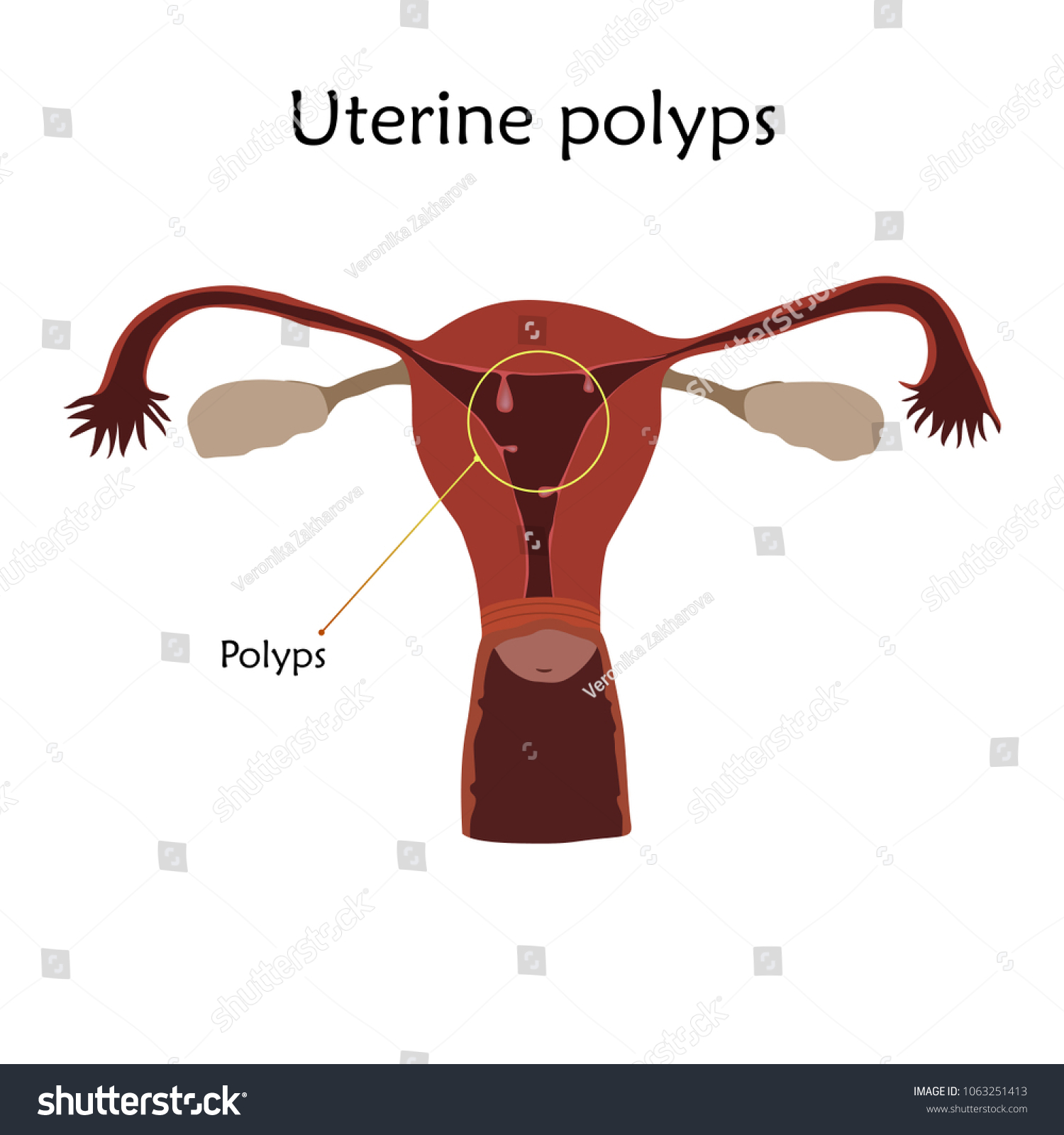 Uterine Polyps Human Realistic Uterus Anatomy Stock Vector (Royalty ...