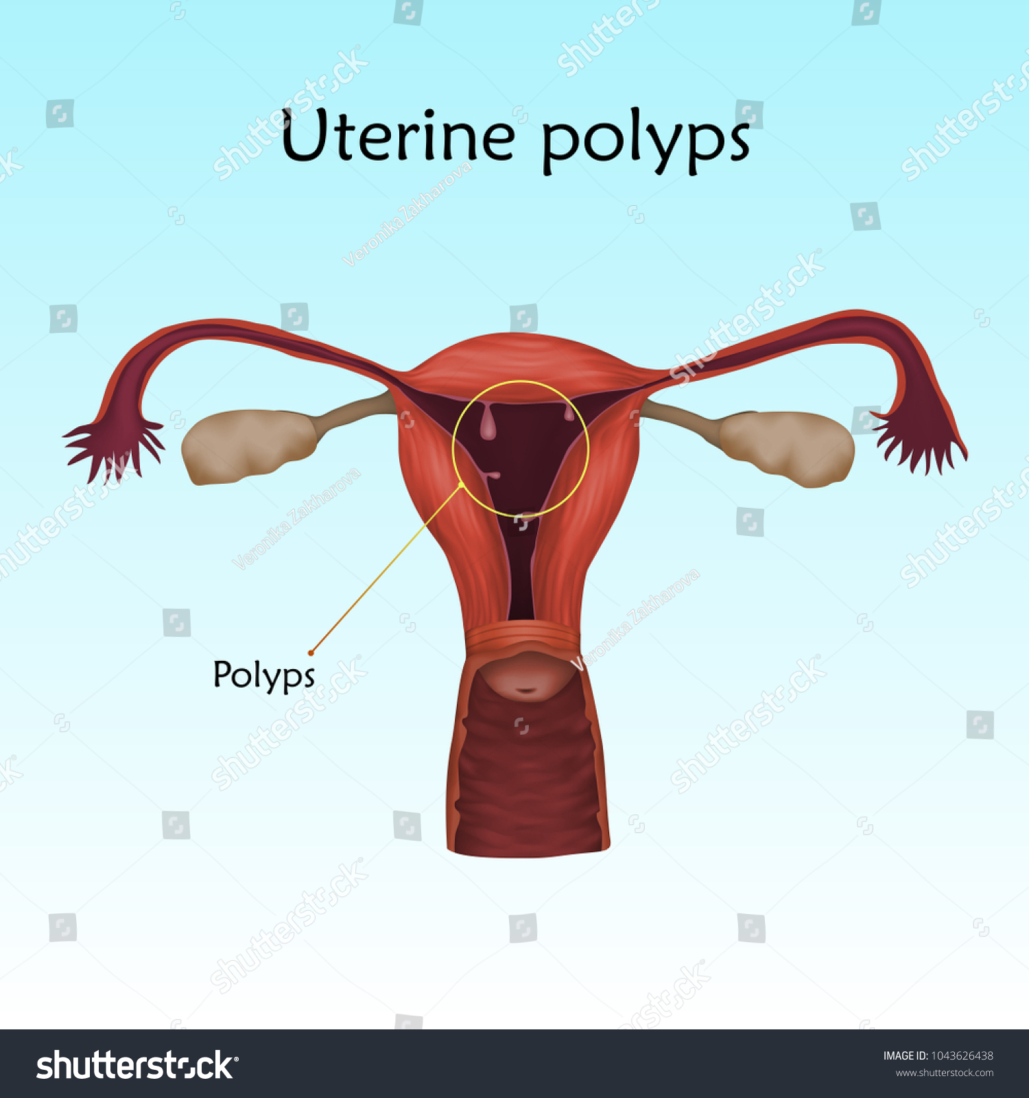 Uterine Polyps Human Realistic Uterus Anatomy 스톡 벡터로열티 프리 1043626438 7272