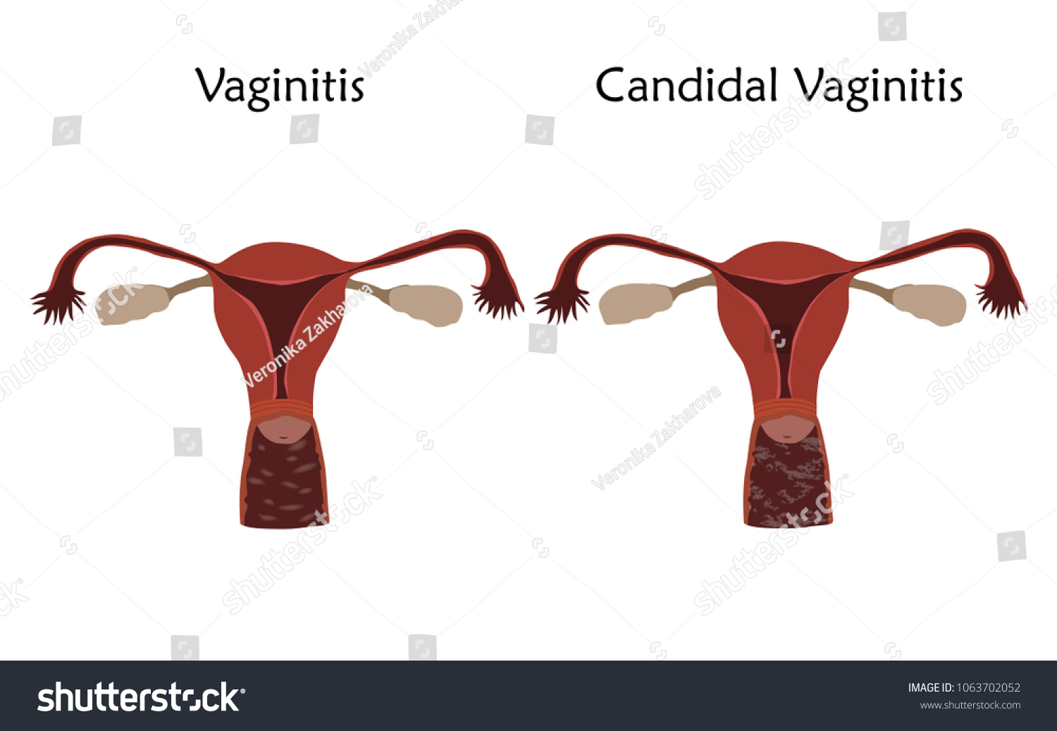 Vaginitis Candidal Vaginitis Human Realistic Uterus Stock Vector ...