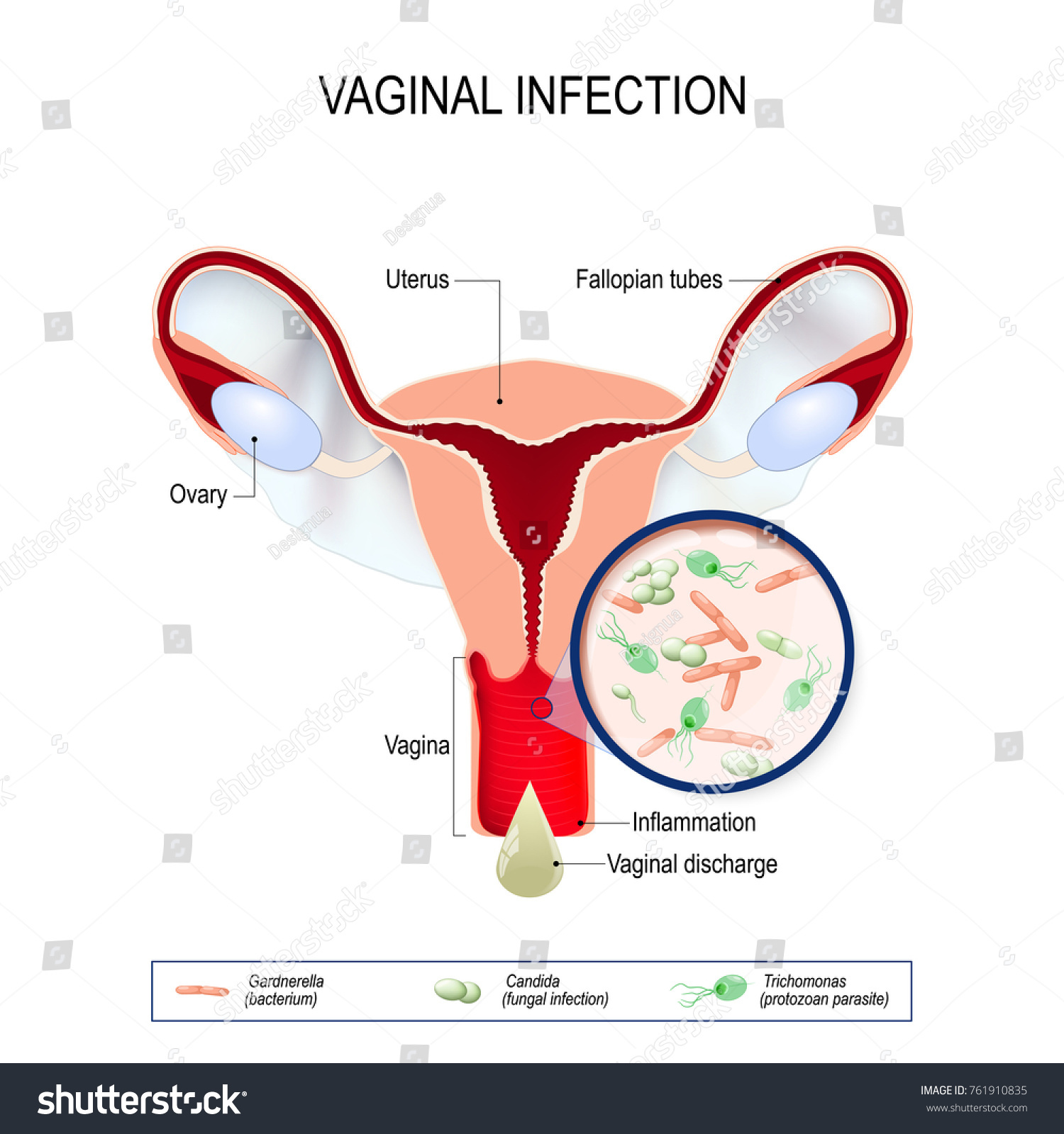 Vaginitis Er En Betaendelse I Vagina Stock Vektor Royaltyfri 761910835