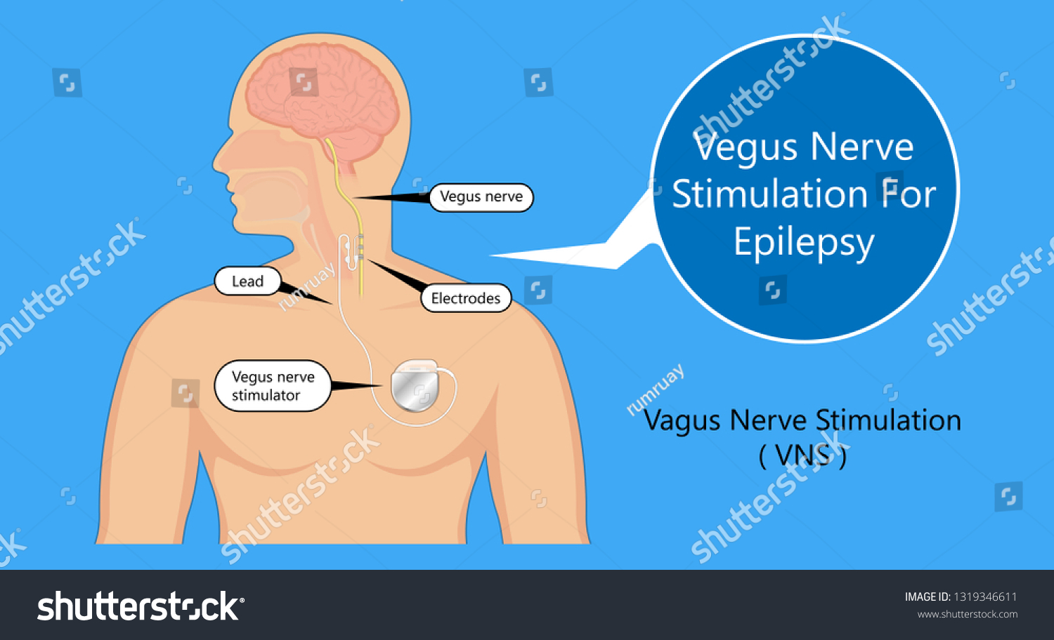 vagus-nerve-stimulation-device-stimulate-electrical