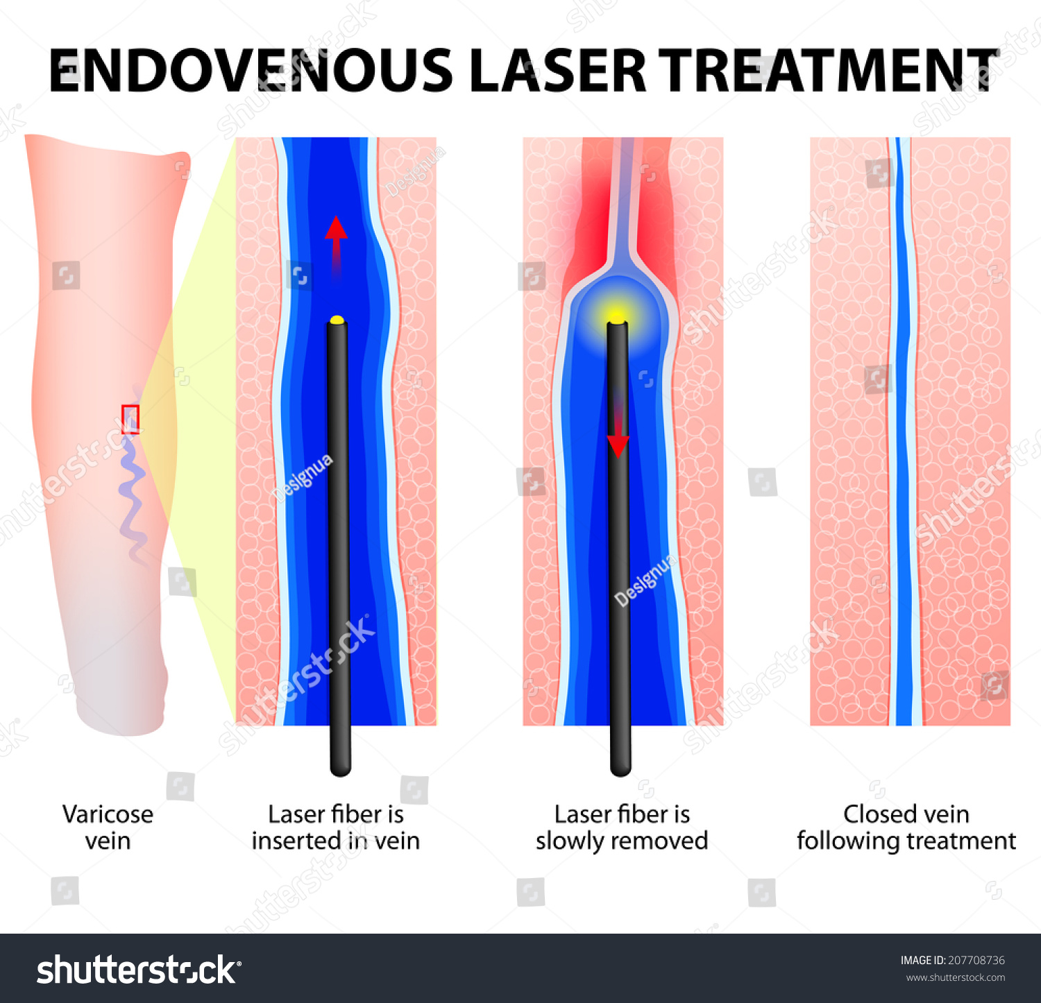 Varicose Veins Endovenous Laser Treatment Laser Stock Vector 207708736