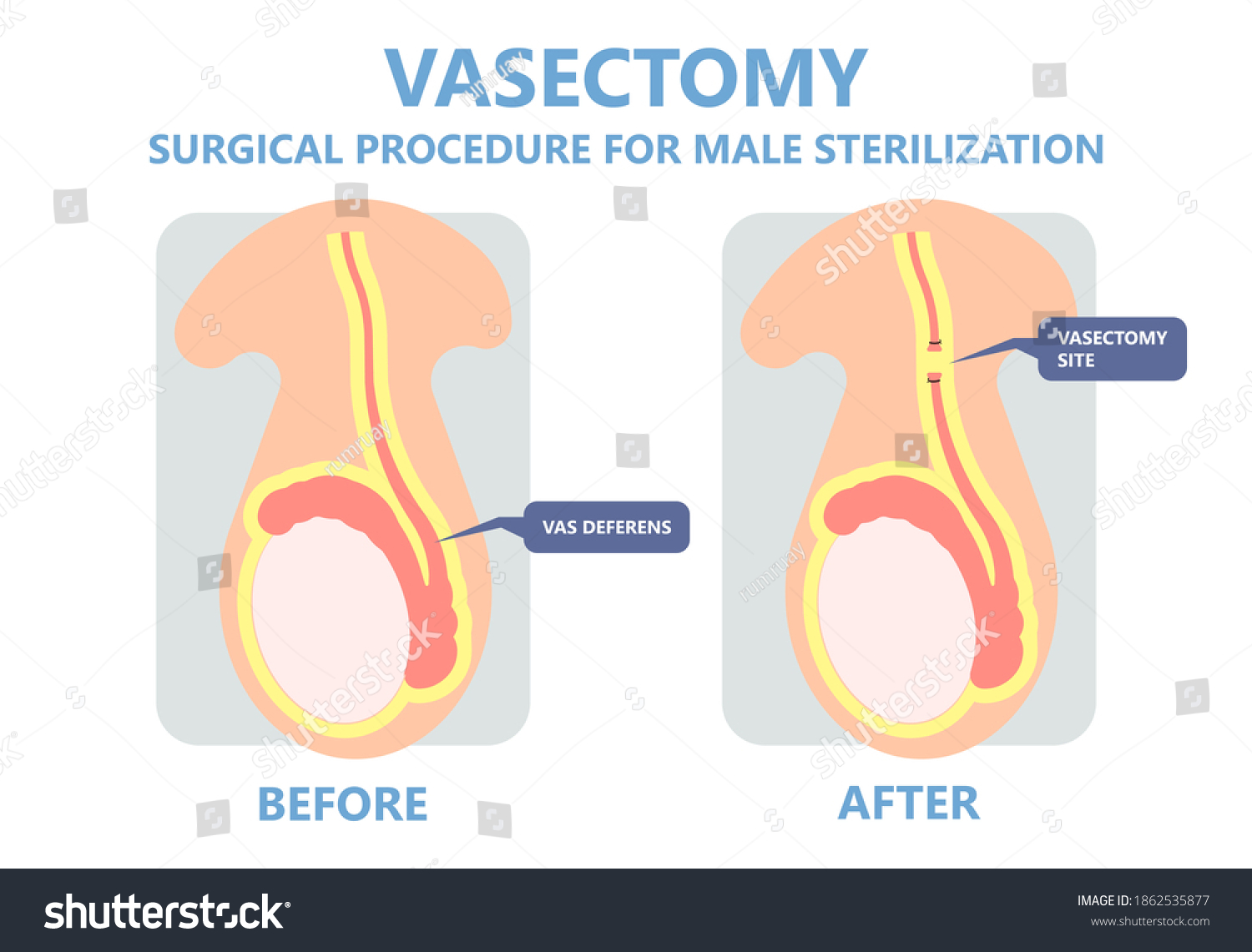 Vasectomy Male Sterilisation Ejaculate Contraceptive Genitalia Stock Vector Royalty Free