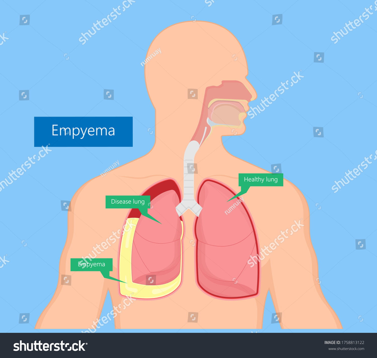 Vats Lung Cancer Treatment Sub Pus Stock Vector Royalty Free 1758813122