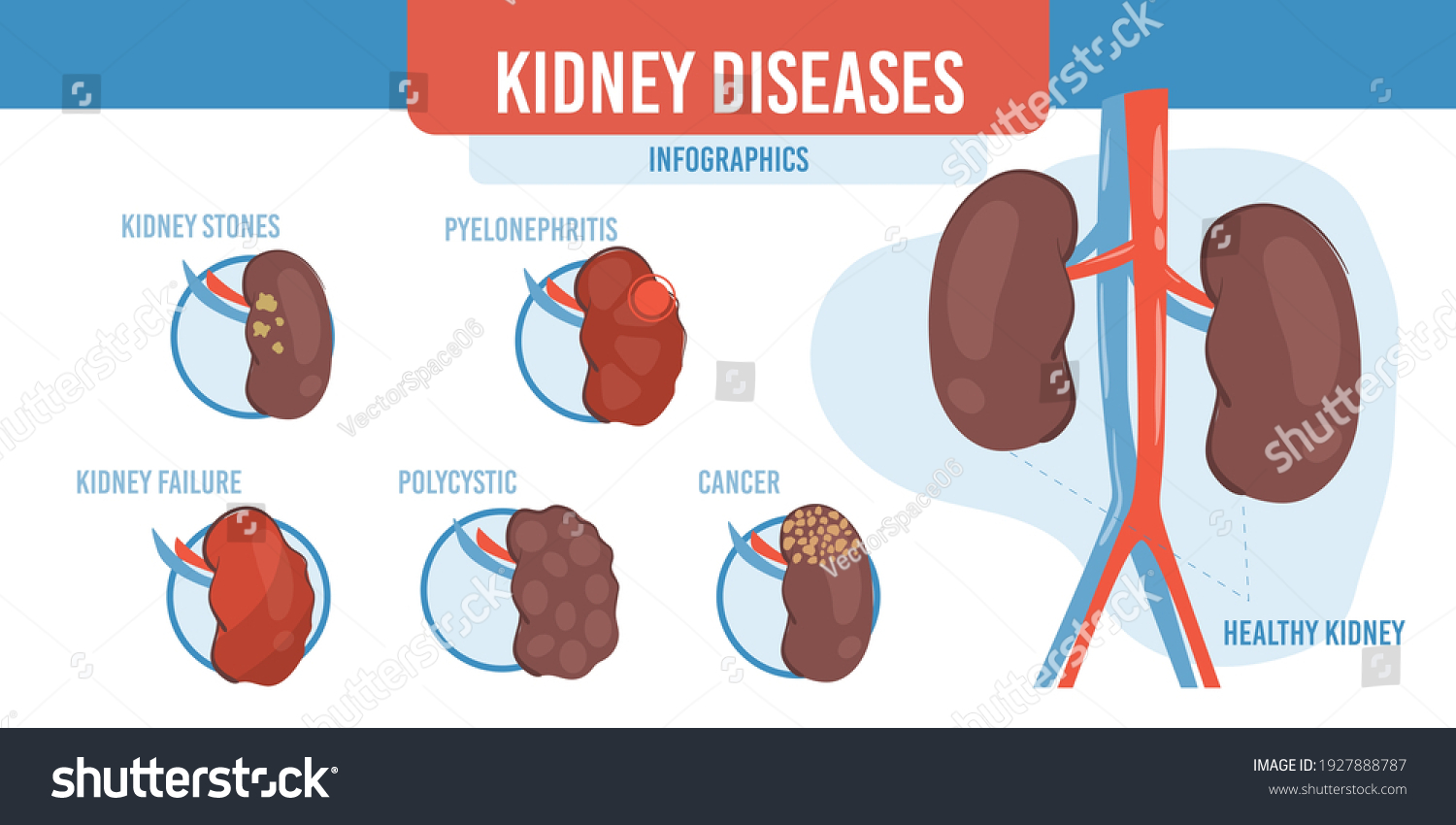 Vector Flat Cartoon Infographichealthy Kidneys List Stock Vector ...