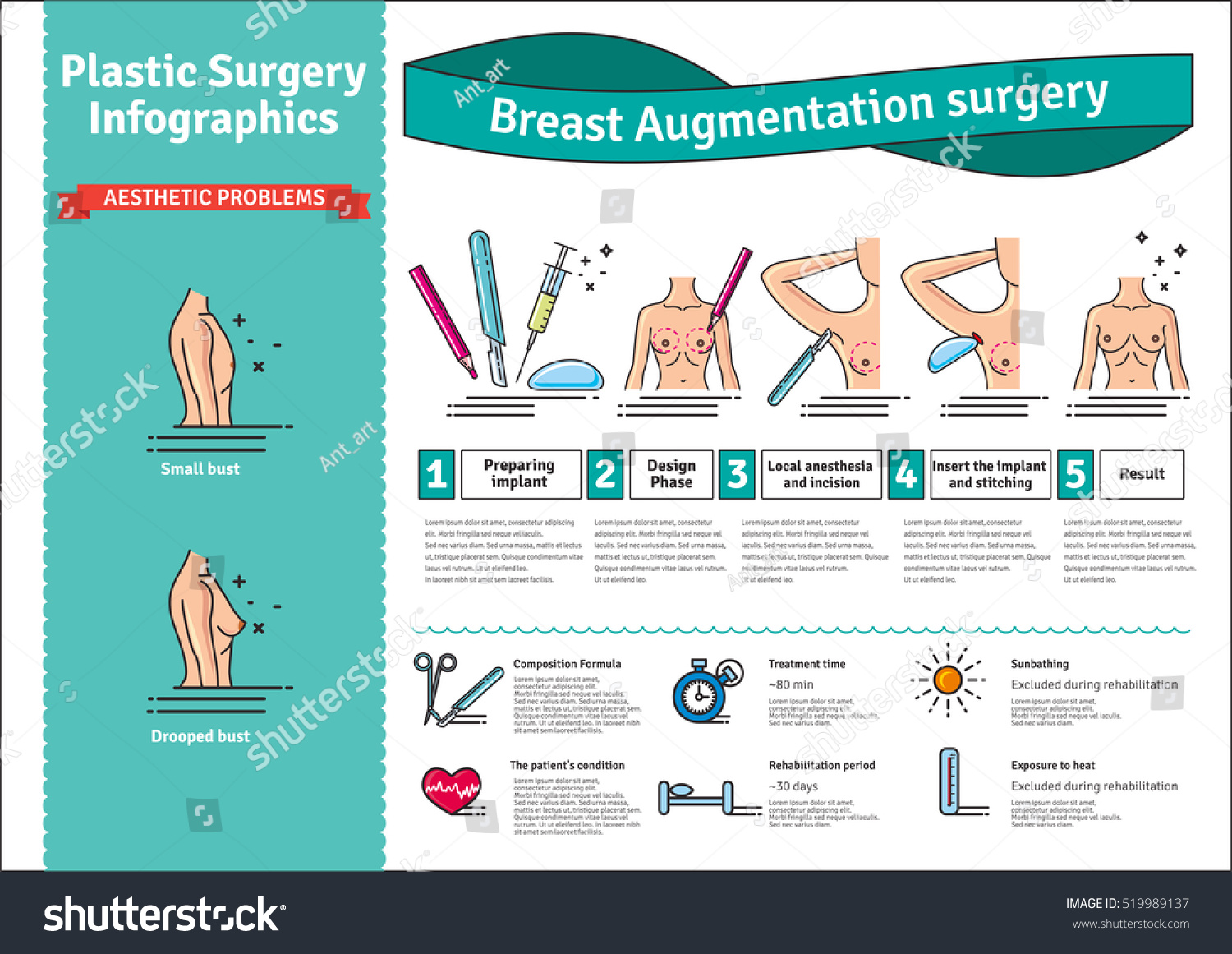 the art of breast augmentation Unlike other methods of breast augmentation that leave scars along the edge of the areola or the fold beneath the breast, transaxillary augmentation avoids any visible scar on the breast 2 approximately 2-inch incision in the armpit. the art of breast augmentation Unlike other methods of breast augmentation that leave scars along the edge of the areola or the fold beneath the breast, transaxillary augmentation avoids any visible scar on the breast 2 approximately 2-inch incision in the armpit.