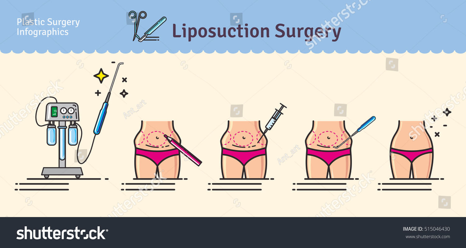 SVG of Vector Illustrated set with liposuction surgery. Infographics with icons of plastic surgery procedures. svg
