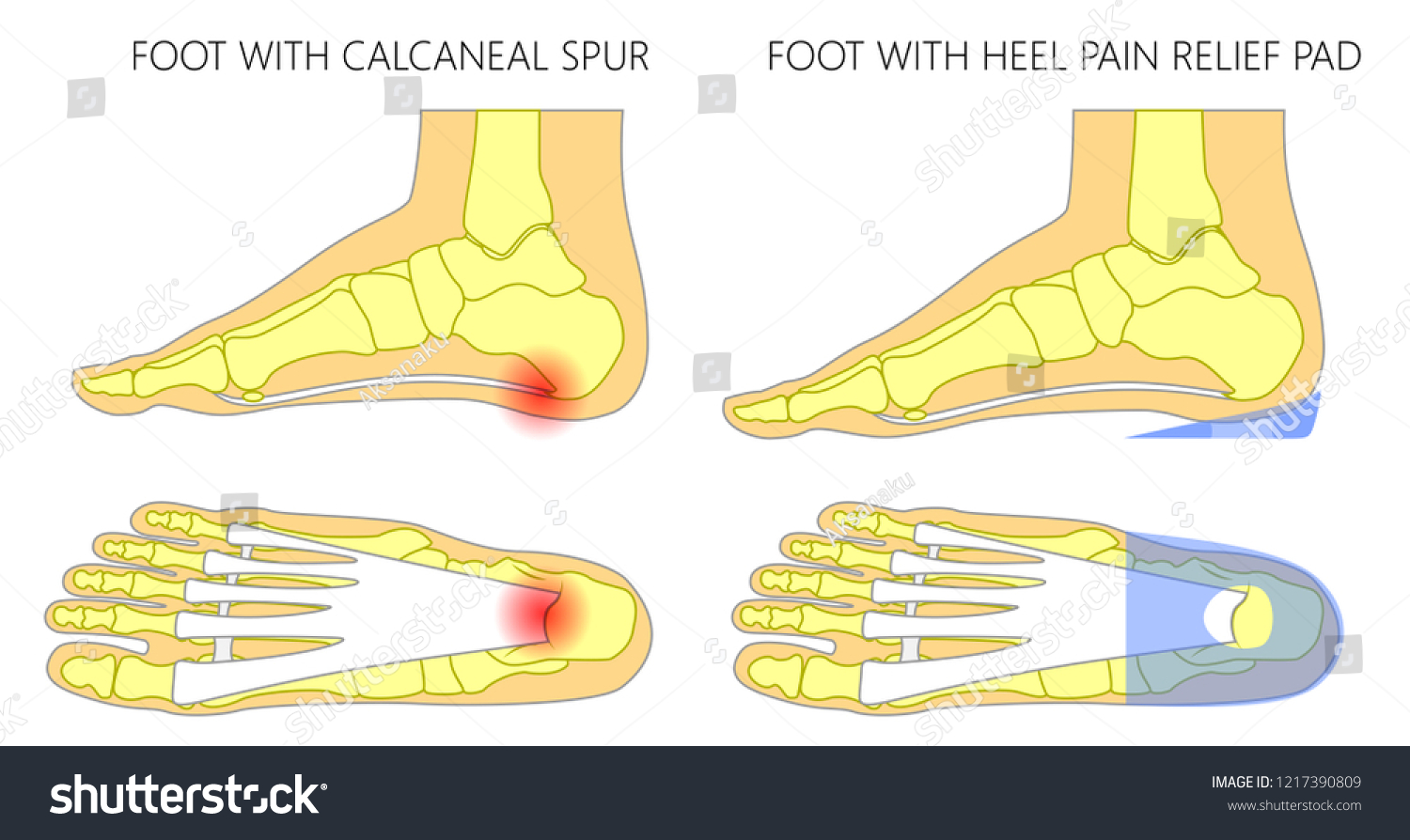 heel spur relief cushions
